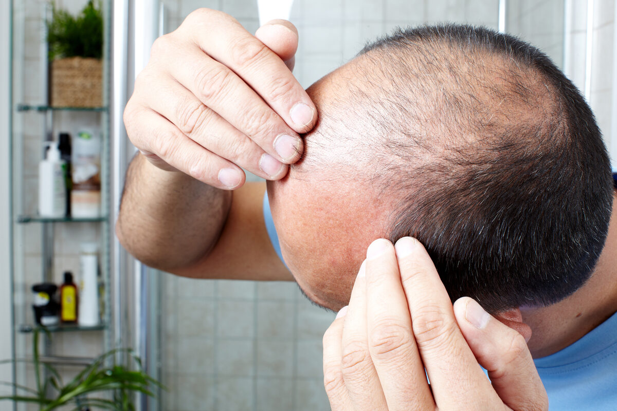 Man examining thinning hair on his crown